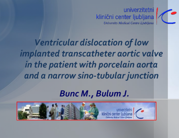 TVT 1092: Ventricular Dislocation of Low-Implanted Transcatheter Aortic Valve in a Patient With Porcelain Aorta and a Narrow Sinotubular Junction