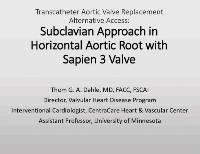 TVT 1148: Supraclavicular Subclavian Access for Sapien Transcatheter Aortic Valve Replacement in a Horizontal Aorta