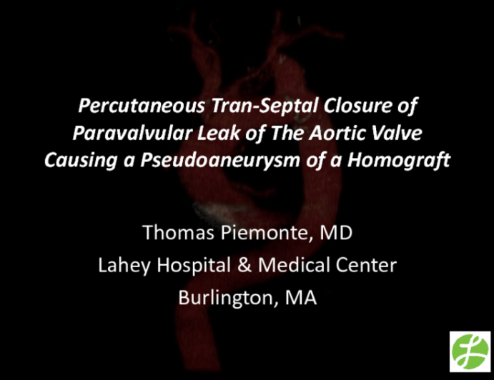 TVT 1045: Percutaneous Transseptal Closure of Paravalvular Leak of the Aortic Valve Causing a Pseudoaneurysm of a Homograft