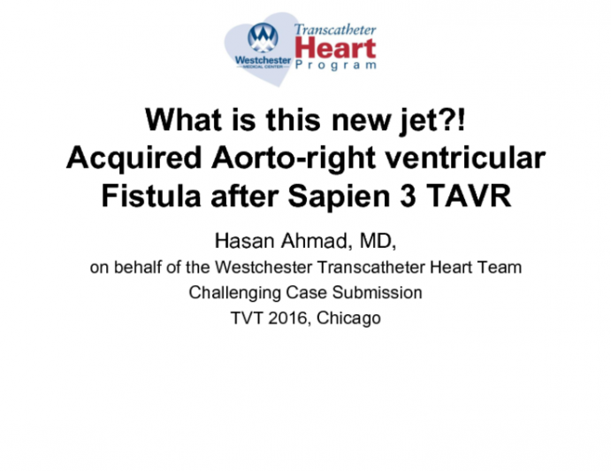 TVT 1079: What Is This New Jet?! Acquired AortoRight Ventricular Fistula After Sapien 3 TAVR