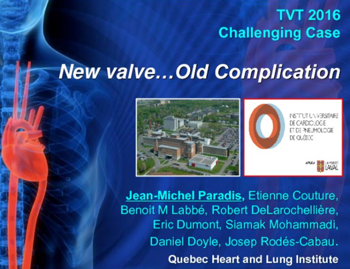 TVT 1098: Stuck Leaflet After Transcatheter Aortic Valve Replacement With a SAPIEN 3 Valve: New Valve... Old Complication