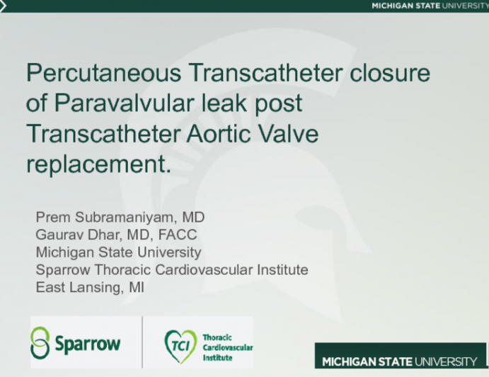 TVT 1105: Percutaneous Transcatheter Closure of Paravalvular Leak After Transcatheter Aortic Valve Replacement