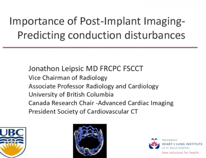 Can CT Imaging Help to Characterize High-Risk Patients for Conduction Disturbances During TAVR?