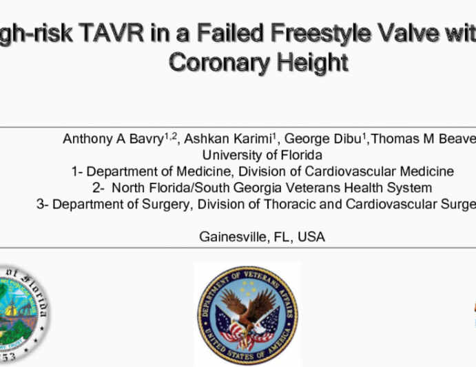 TVT 1011: High-Risk TAVR in a Failed Freestyle Valve With Low Coronary Height