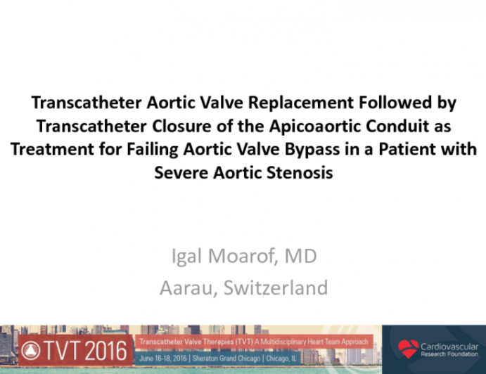 TVT 1055: Transcatheter Aortic Valve Replacement Followed by Transcatheter Closure of the Apicoaortic Conduit as Treatment for Failing Apicoaortic Conduit in a Patient With Severe Aortic Stenosis