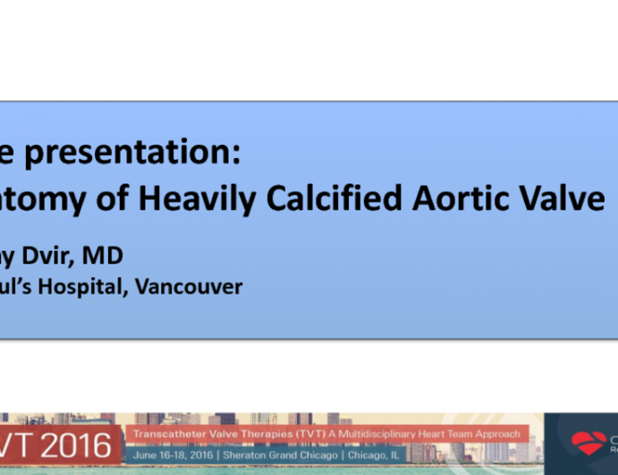 Anatomy of Heavily Calcified Aortic Valve