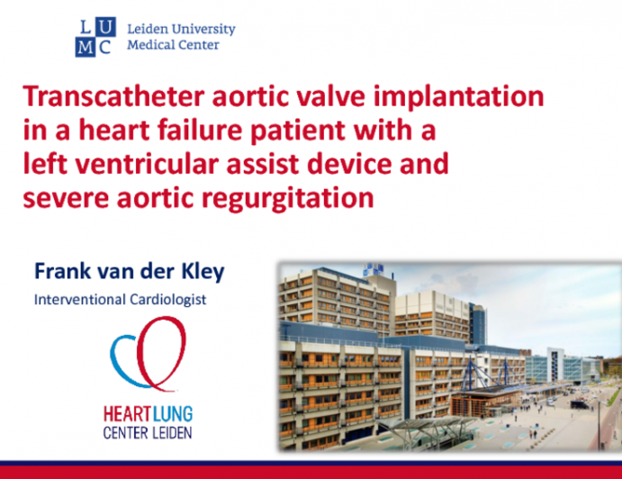 TVT 1130: Transcatheter Aortic Valve Implantation in a Heart-Failure Patient With a Left Ventricular Assist Device and Severe Aortic Regurgitation