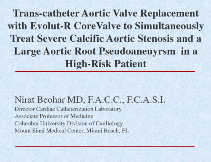 TVT 1039: Transcatheter Aortic Valve Replacement With Evolut-R CoreValve to Simultaneously Treat Severe Calcific Aortic Stenosis and a Large Aortic Root Pseudo-aneurysm in a High-risk Patient