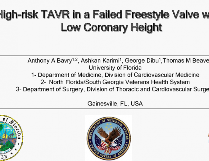 TVT 1011: High-Risk TAVR in a Failed Freestyle Valve With Low Coronary Height