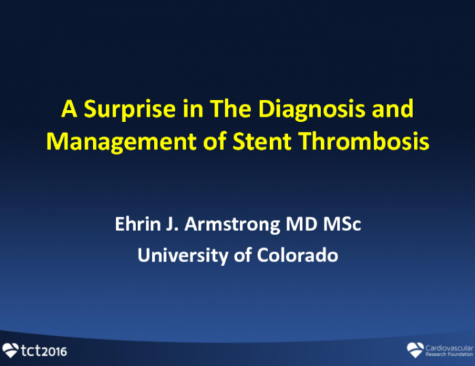 Case Presentation: A Surprise in the Evaluation and Management of Stent Thrombosis