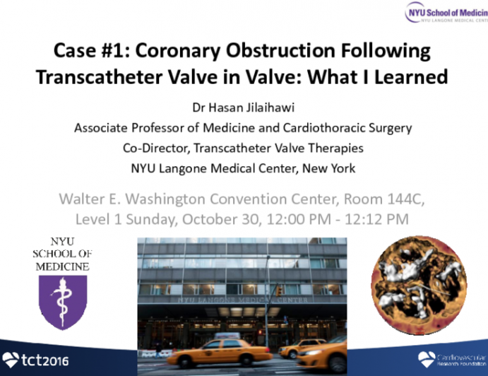 Case #1: Coronary Obstruction Following Transcatheter Valve in Valve: What I Learned