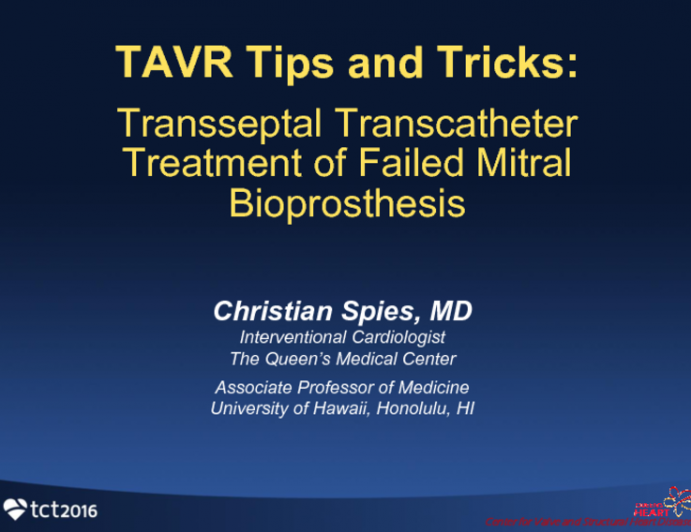 Case #4: Transseptal Transcatheter Treatment of Failed Mitral Bioprosthesis (With Tips and Tricks)
