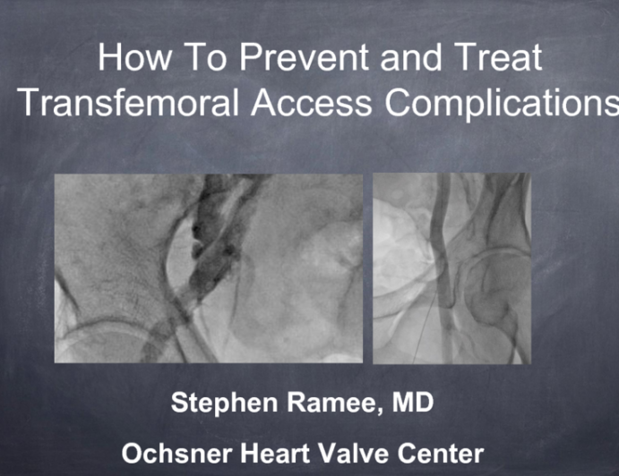 Complications 2. How to Prevent and Treat Transfemoral Access Site Complications