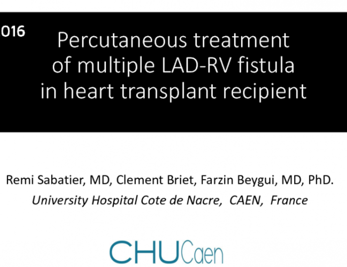 TCT 1631: Percutaneous Treatment of Multiple LAD-RV Fistula in Heart Transplant Recipient