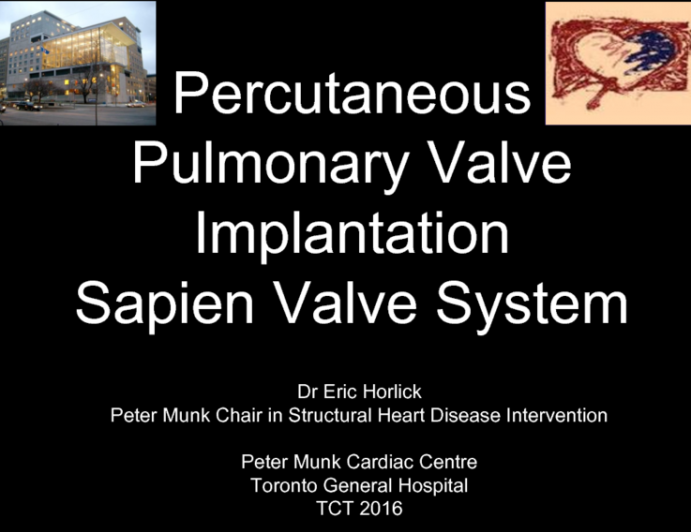 Transcatheter Pulmonary Valve Replacement 2: Sapien