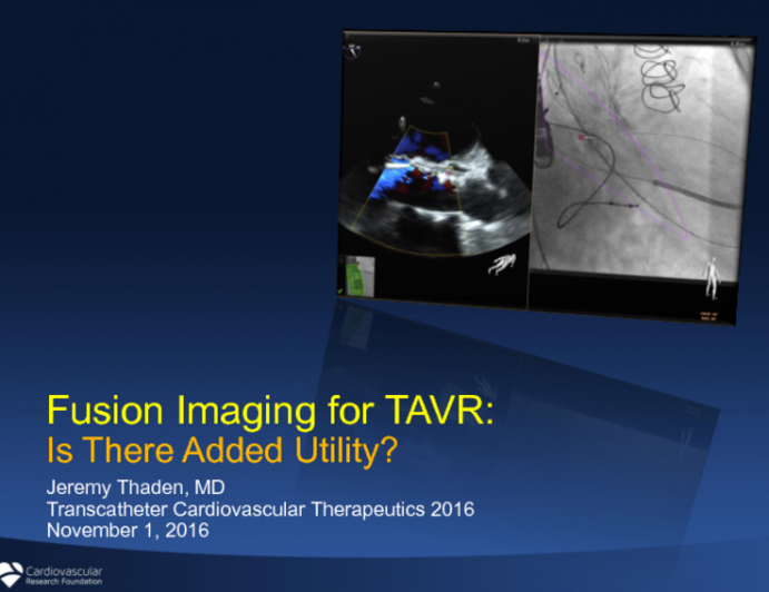 Fusion Imaging for TAVR: Is There Added Utility?