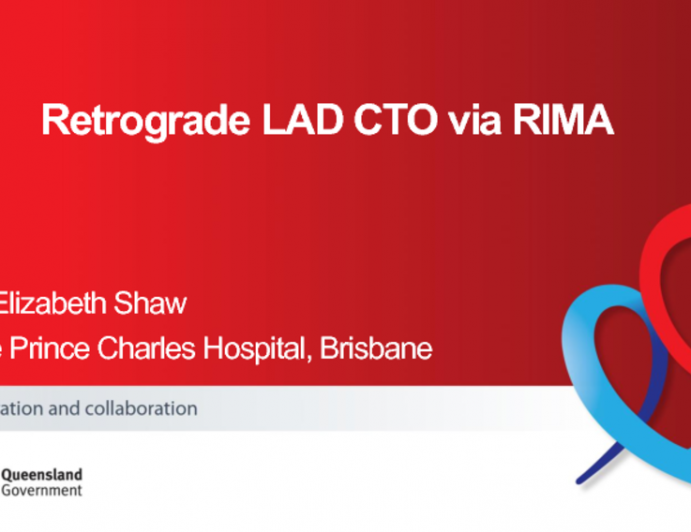 TCT 1103: Retrograde LAD Chronic Total Occlusion via RIMA