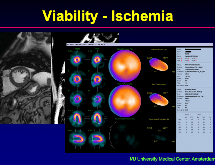 Assessment of Ischemia in CTOs