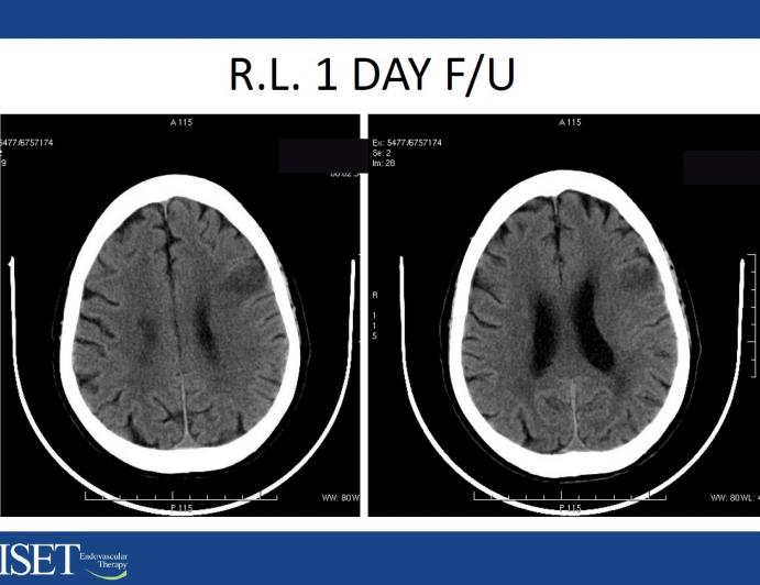 Imaging of Acute Stroke: What You Need to Make a Decision to Treat
