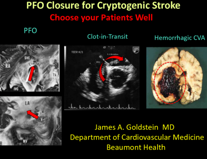 PFO Closure for Cryptogenic Stroke Choose your Patients Well