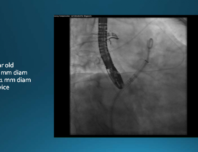 Case: 67 year old CT 25 mm diam TEE 21 mm diam 27 device