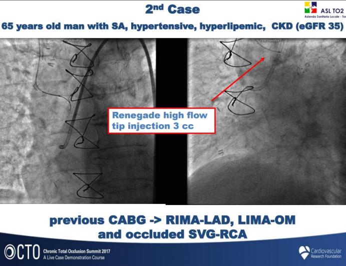 CTO PCI in Patients With Renal Insufficiency