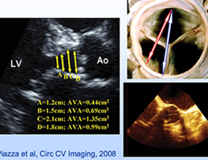 Doppler Echocardiography Hemodynamic Assessment