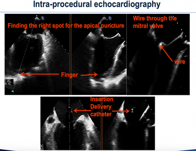 3D-Echocardiographic Guiding of a Novel Transcatheter Mitral Valve Replacement