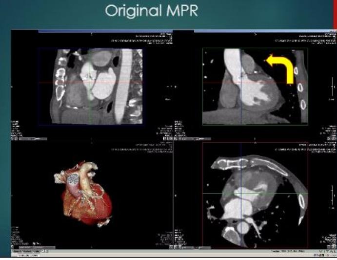 CT Assessment of the Aortic  Annulus for TAVR: What  Measurements are Important  and How to Obtain Them