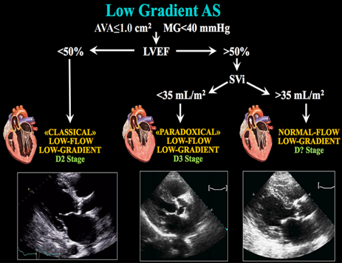 Low Gradient, Severe Aortic Stenosis