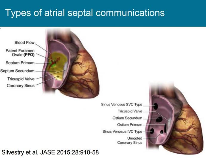  Guidelines: Assessment of ASD and PFO and Evaluation of a Cardiac Source of Embolism