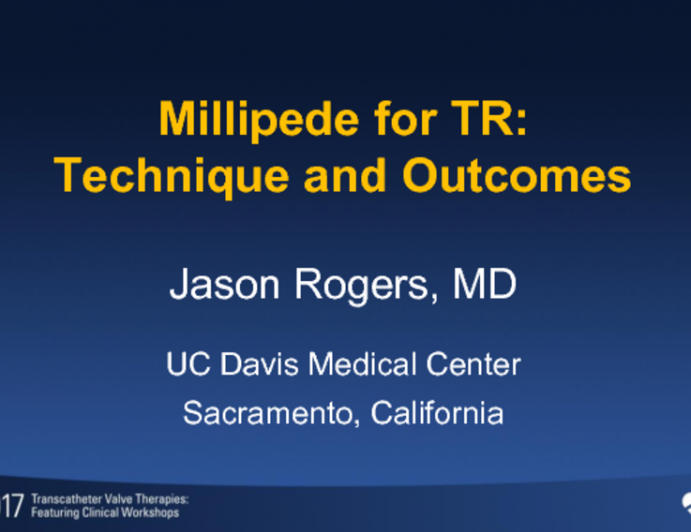 Millipede for TR: Technique and Outcomes