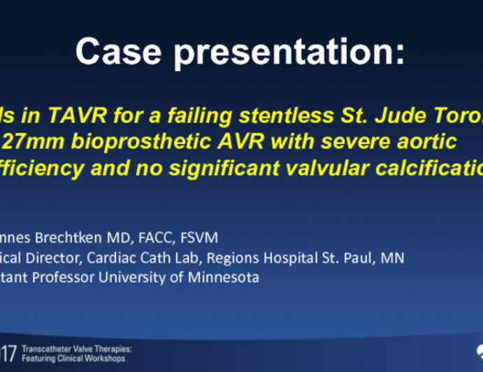 Pitfalls in TAVR for Failing Stentless St. Jude Toronto 27mm Bioprosthetic AVR With Severe Aortic Insufficiency and No Significant Valvular Calcification