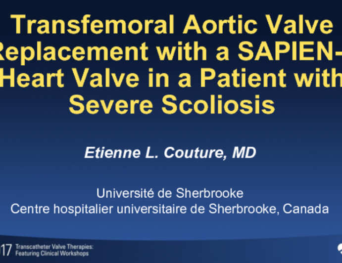 Transfemoral Aortic Valve Replacement With a SAPIEN-3 Heart Valve in a Patient With Severe Scoliosis: A Roller Coaster Ride