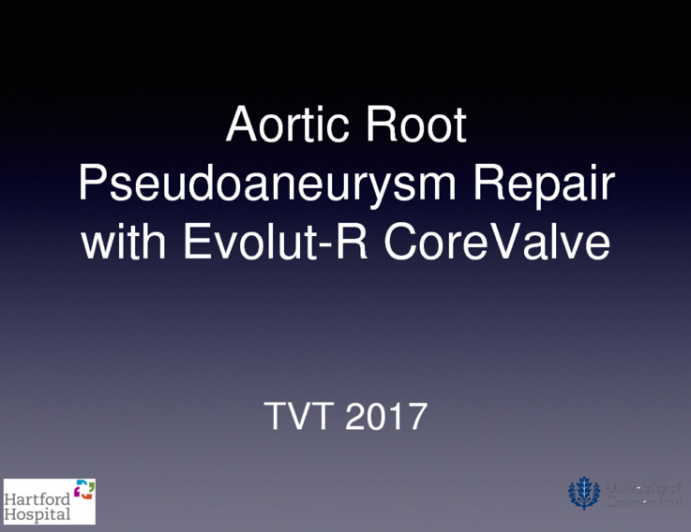 Aortic Root Pseudo-aneurysm Repair With Evolut-R CoreValve