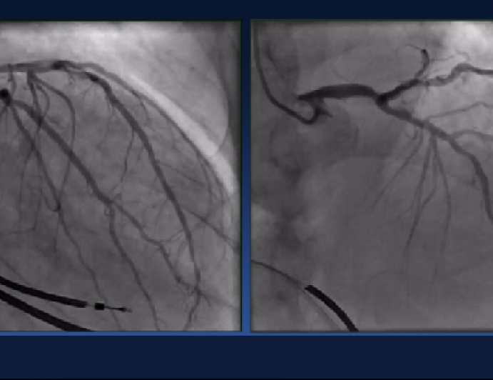 CABG vs PCI vs Mechanical Support