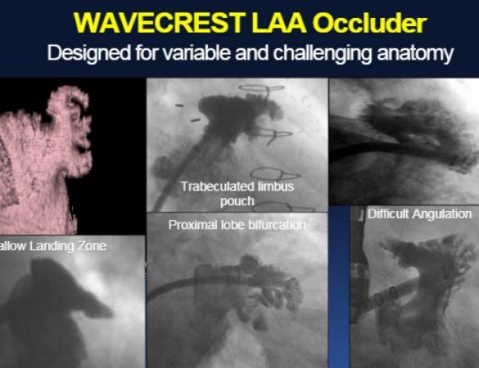 Early and Late Results With the Wavecrest LAA Occluder (and Future Studies)
