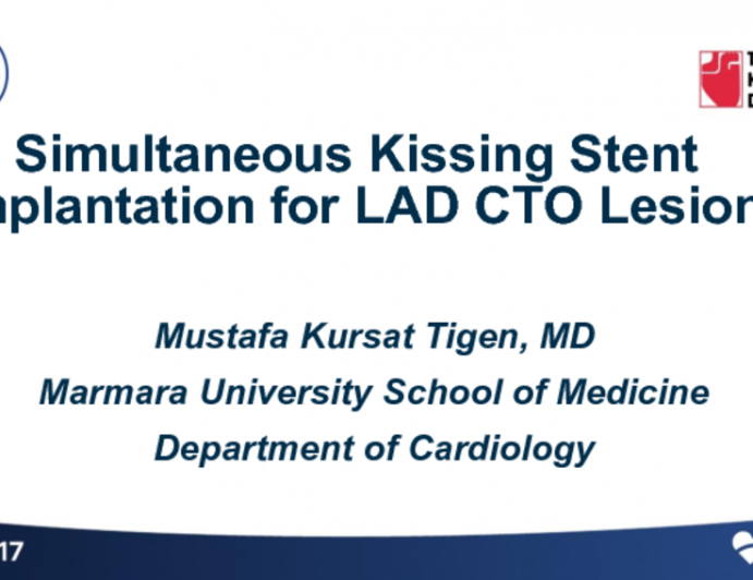 Simultaneous Kissing Stent Implantation for LAD CTO Lesion