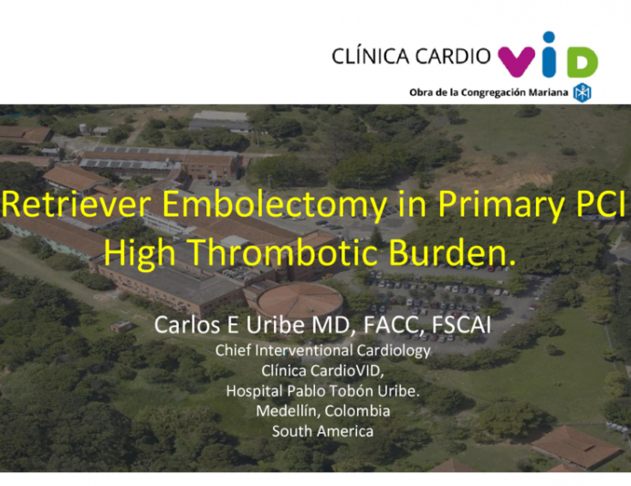 Interventional Innovation Highlight: Stent Retriever Embolectomy in Primary PCI With High Thrombotic Burden