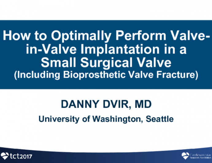 How to Optimally Perform Valve-in-Valve Implantation in a Small Surgical Valve (Including Bioprosthetic Valve Fracture) – Case Examples