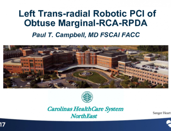 Left Trans-Radial Robotic PCI of Obtuse Marginal