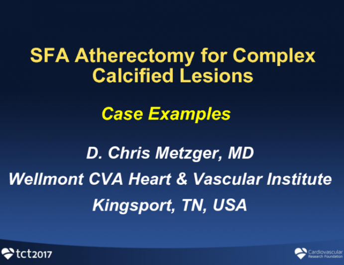 SFA Atherectomy for Complex Calcified Lesions: Case Examples and Data