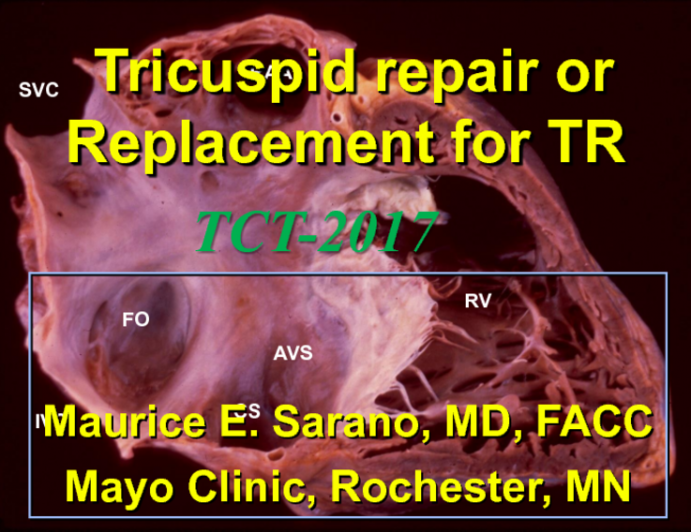 Tricuspid Valve Repair and Replacement for CHF