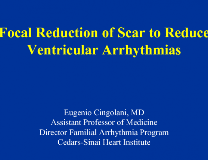 Focal Reduction of Scar to Reduce Ventricular Arrhythmias