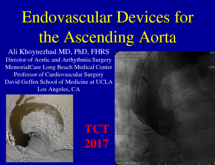 Endovascular Devices for the Ascending Aorta
