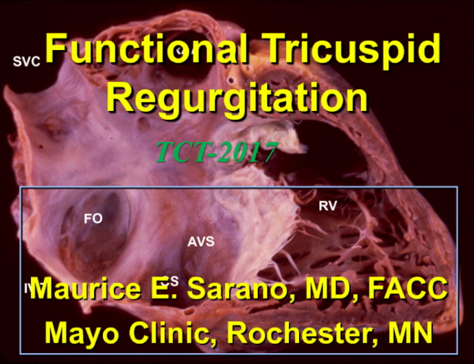 Etiologies and Prognosis of Secondary Tricuspid Valve Disease