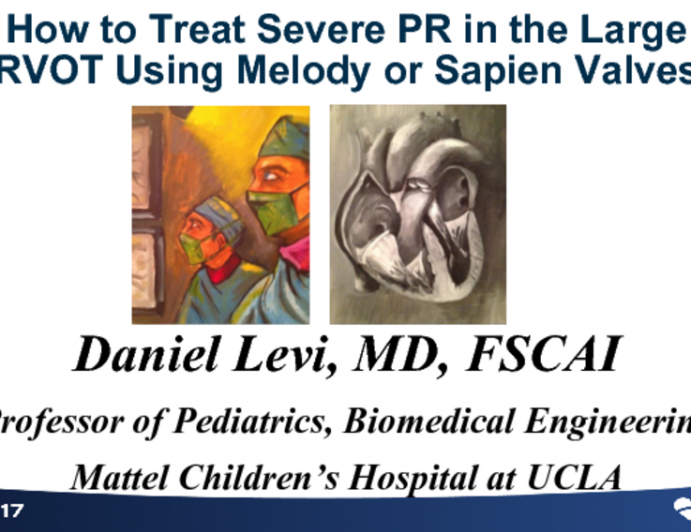 How to Treat Severe PR in the Large RVOT Using Melody or Sapien Valves