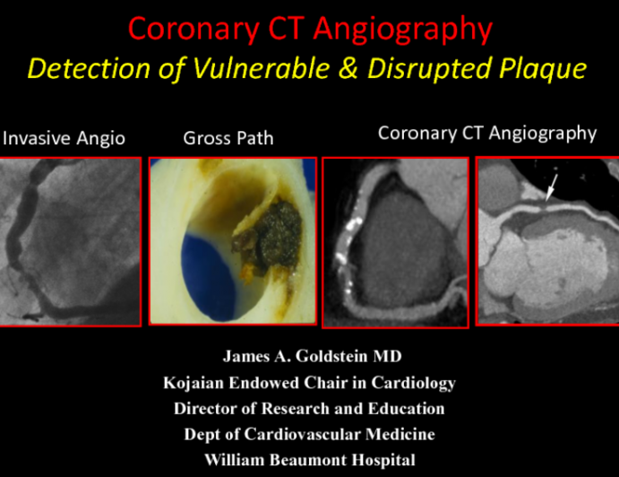 Current State-of-the-Art: Identification of Vulnerable Patients and Plaques With Noninvasive Testing