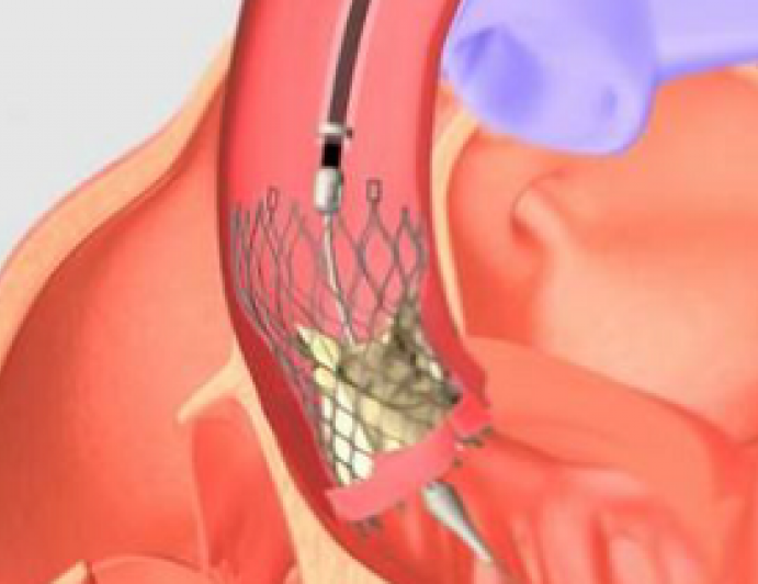 TAVR Tips and Tricks: How to Succeed with Challenging Cases