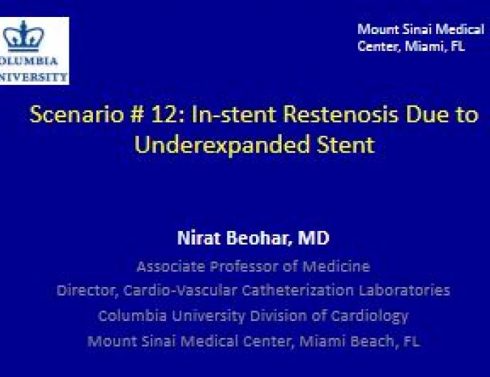 In-stent Restenosis Due to Underexpanded Stent